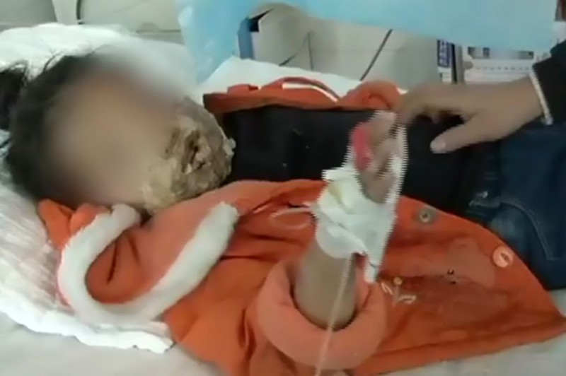 三星Note 4爆炸 中國四歲女孩睡夢中被燒傷