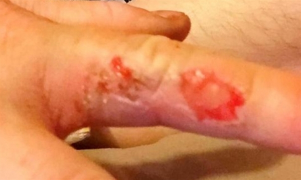 索尼手機也爆炸了：機主被燒慘