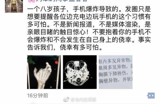 充電手機突然爆炸 廣西12歲男孩手指被炸斷眼球被炸傷