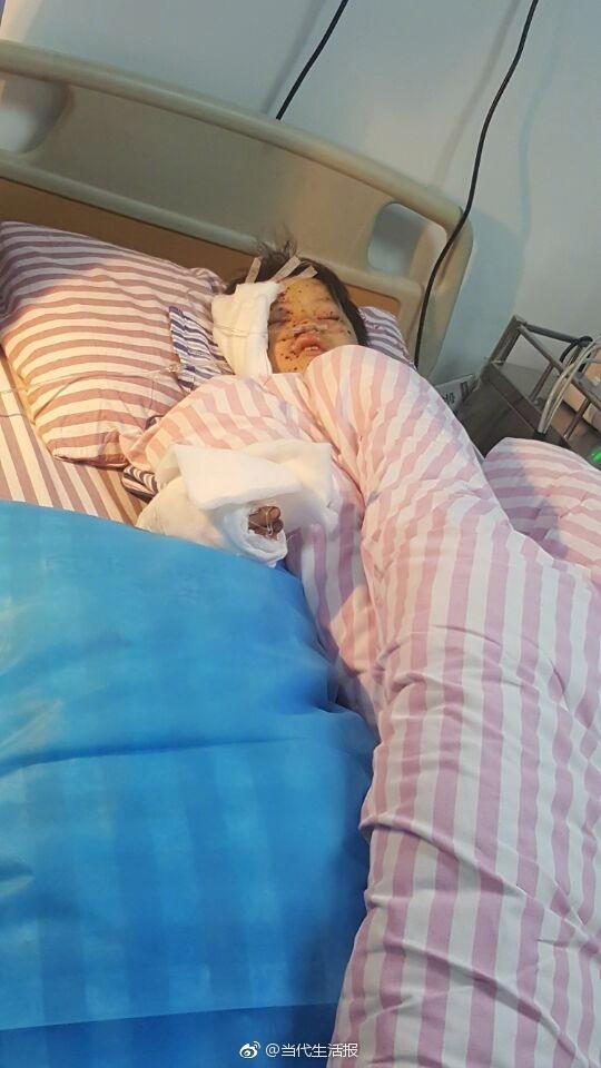 充電手機突然爆炸 廣西12歲男孩手指被炸斷眼球被炸傷